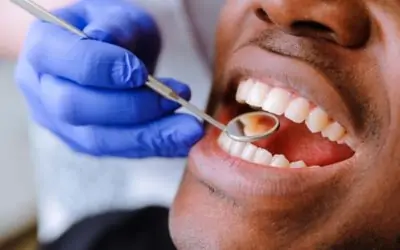 How Dentists Use Dental Crowns in Cosmetic Dentistry