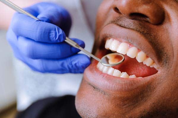 How Dentists Use Dental Crowns in Cosmetic Dentistry