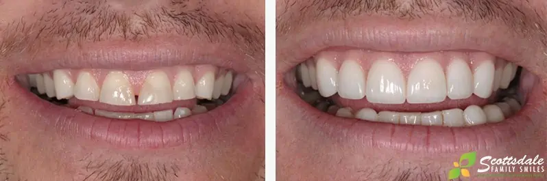 A before and after photo showing a patient's more natural-looking teeth after getting dental veeners