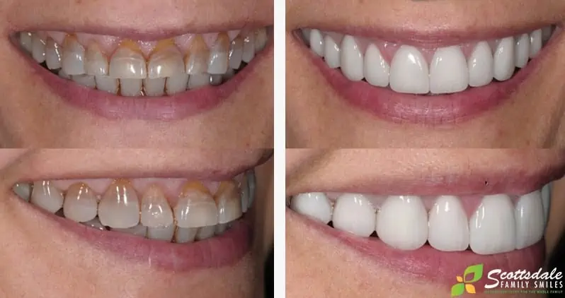 A before and after photo showing a patient with whiter, more natural-looking teeth after receiving dental veneers