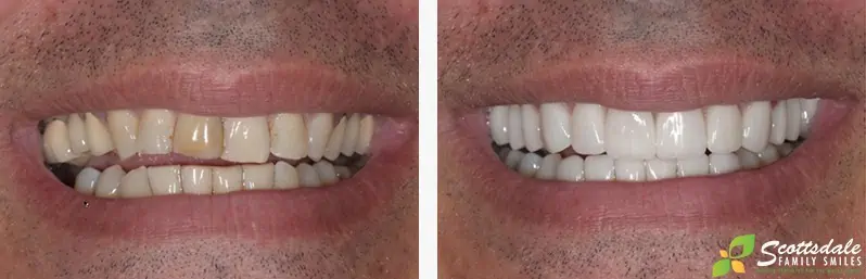 A before and after photo showing a patient's whiter, straighter teeth after getting veneers