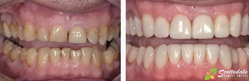 A before and after photo showing a patient's straighter, healtheir-looking teeth after getting veneers
