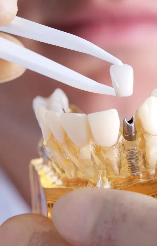 Dental Implants