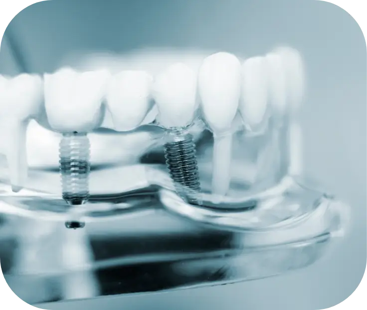 Dental Implant Care