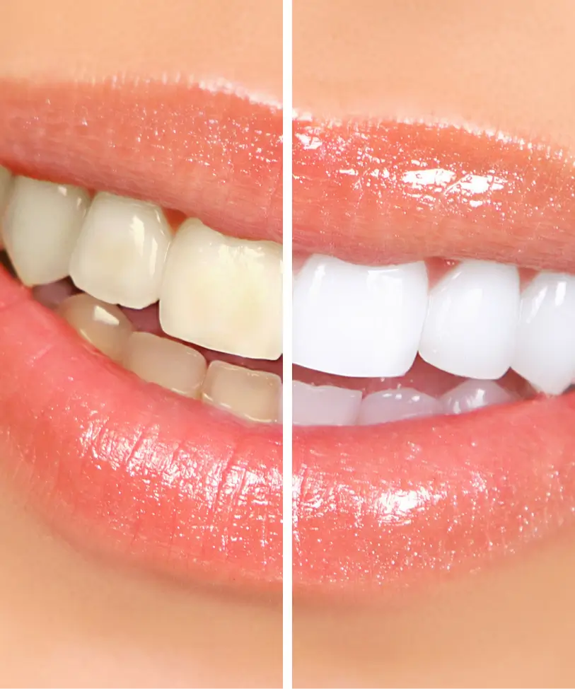 Before and after teeth whitening