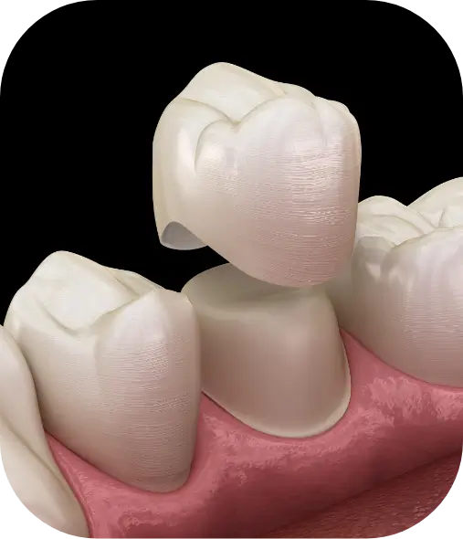 What Are Dental Bridges?