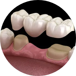 Dental Bridges