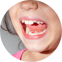 Misaligned Teeth