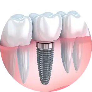 Dental Implants