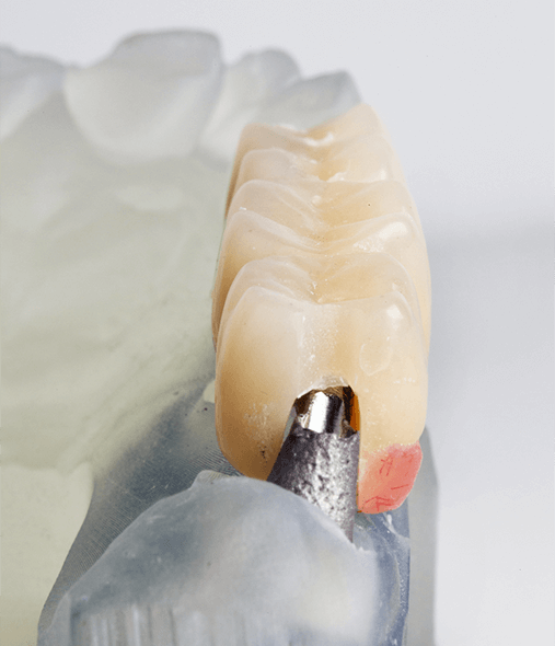 Dental bridge