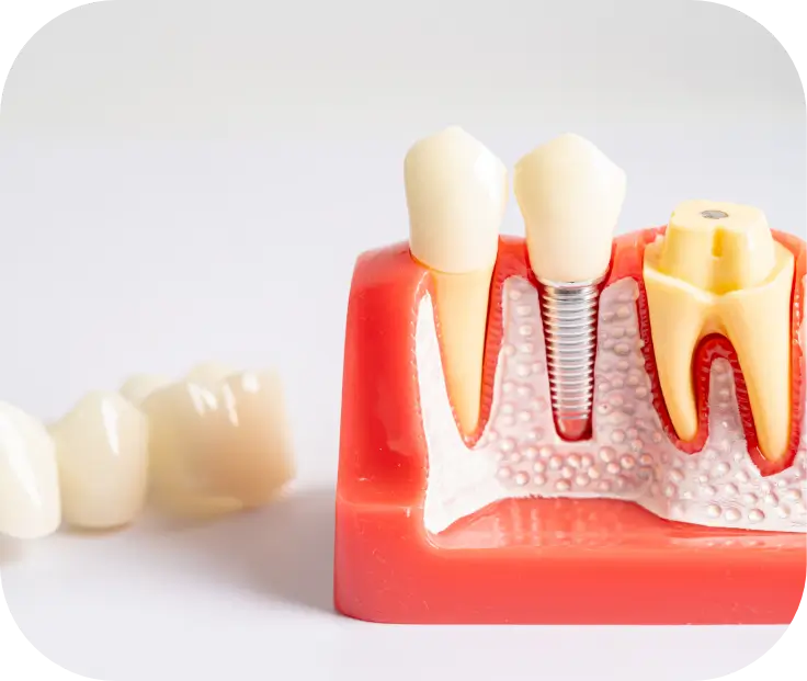 Preparing Dental Implants