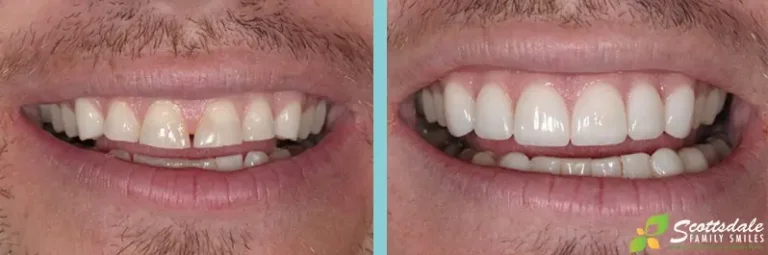 Dental Crowns Before and After