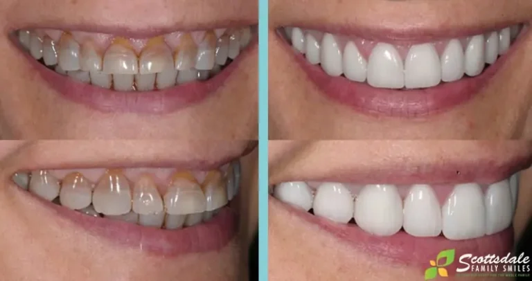 Dental Crowns Before and After