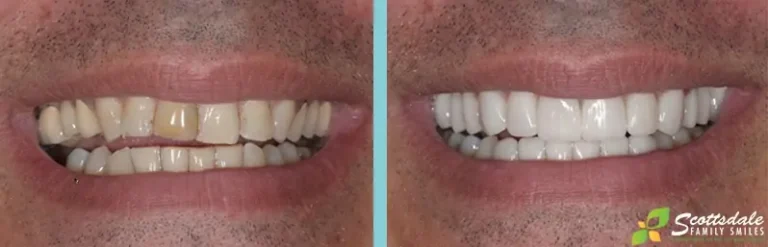 Dental Crowns Before and After