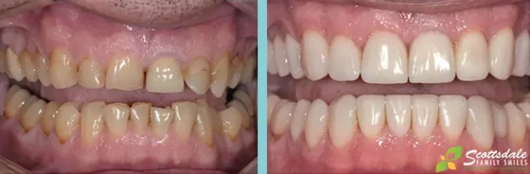 Dental Crowns Before and After